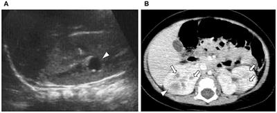 Successful Treatment of Cyst Infection in an Infant With Autosomal Dominant Polycystic Kidney Disease Using Trimethoprim/Sulfamethoxazole